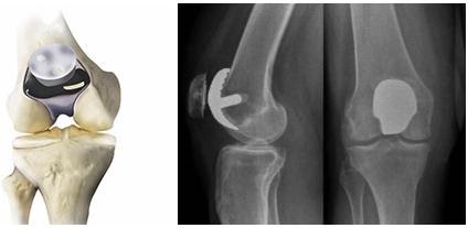 Patella Femoral Arthritis